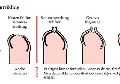 Fra Cupido Arkiv: Nyttig å vite om forhuden